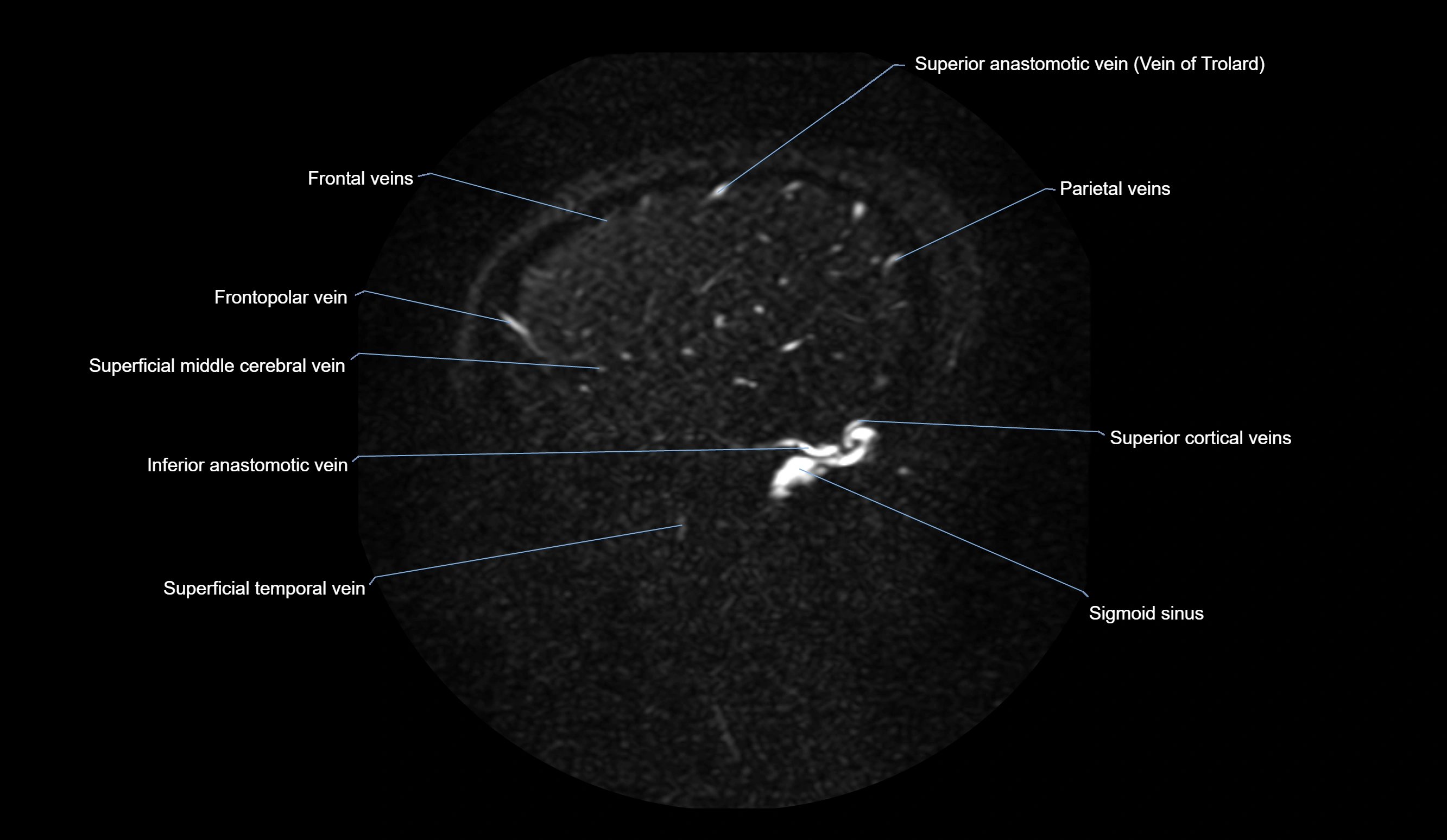 MRV brain sagittal anatomy 3T MRI images -img-01015-00068.webp